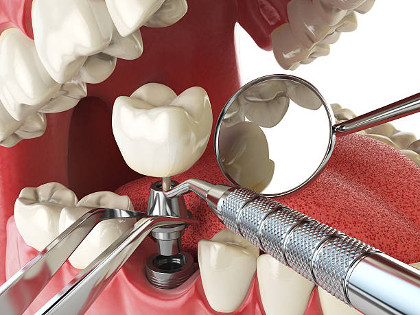 Best Emergency Tooth Extraction in Refugio, TX